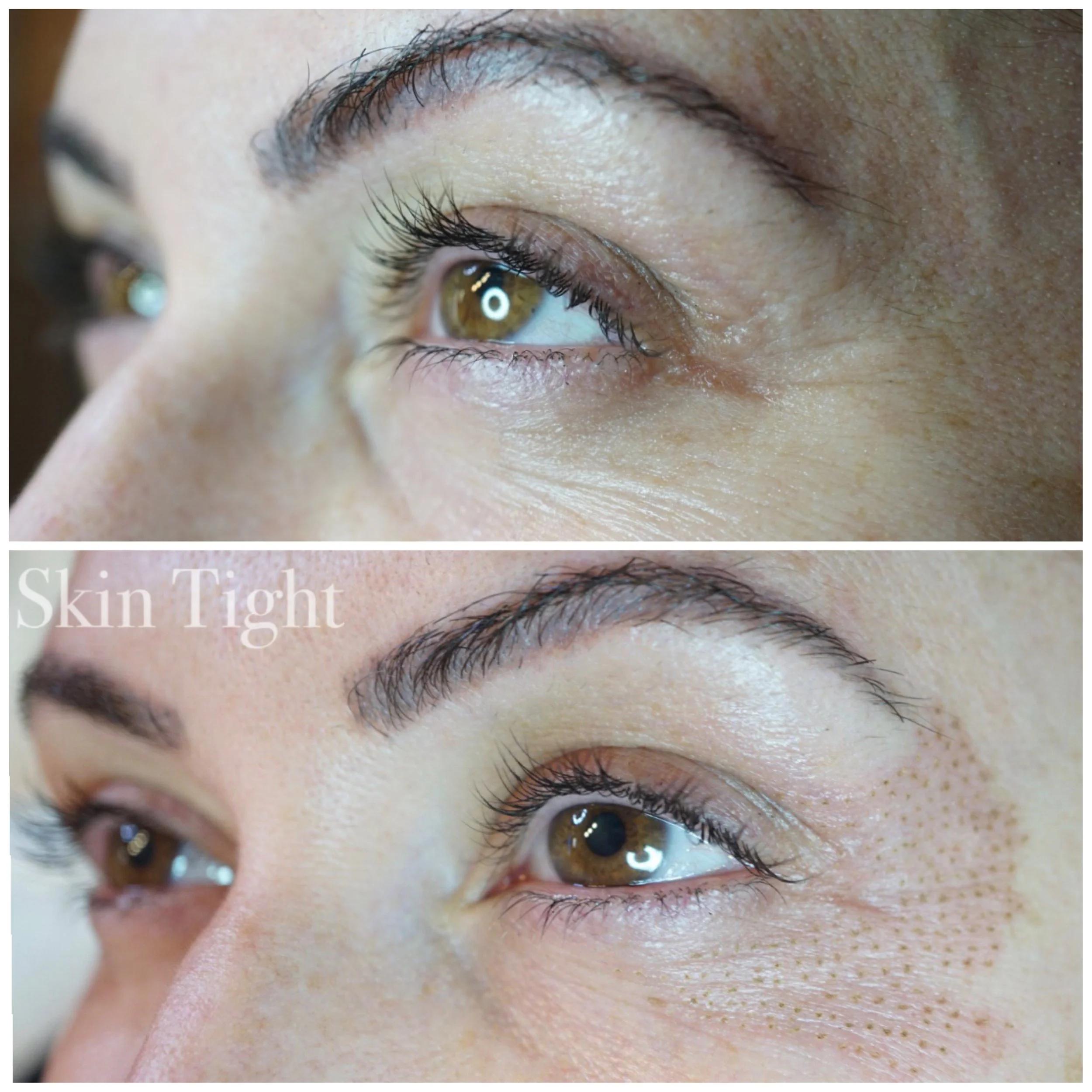 fibroblast plasma lift