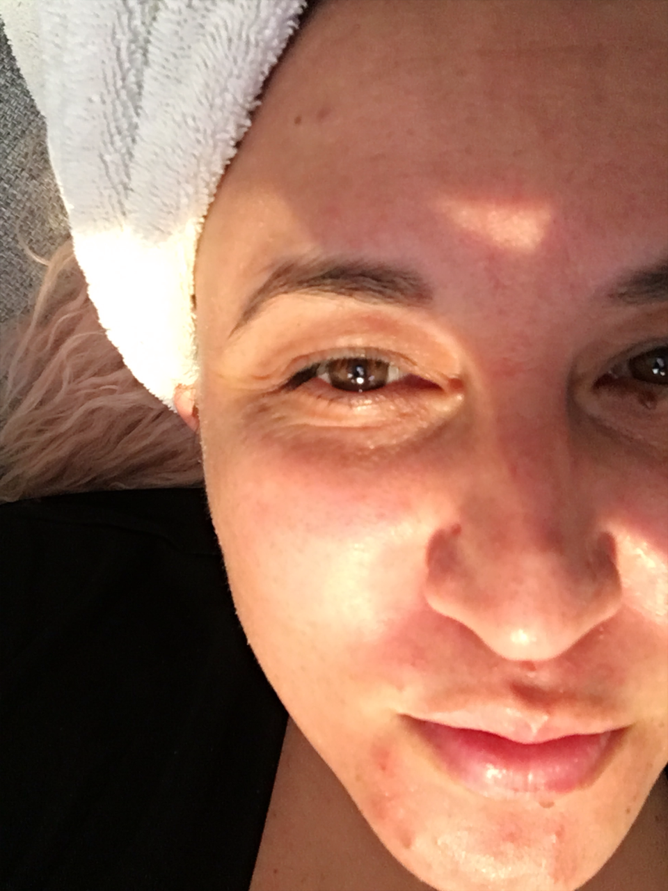 Day 3 Afternoon..Chin is really peeling.