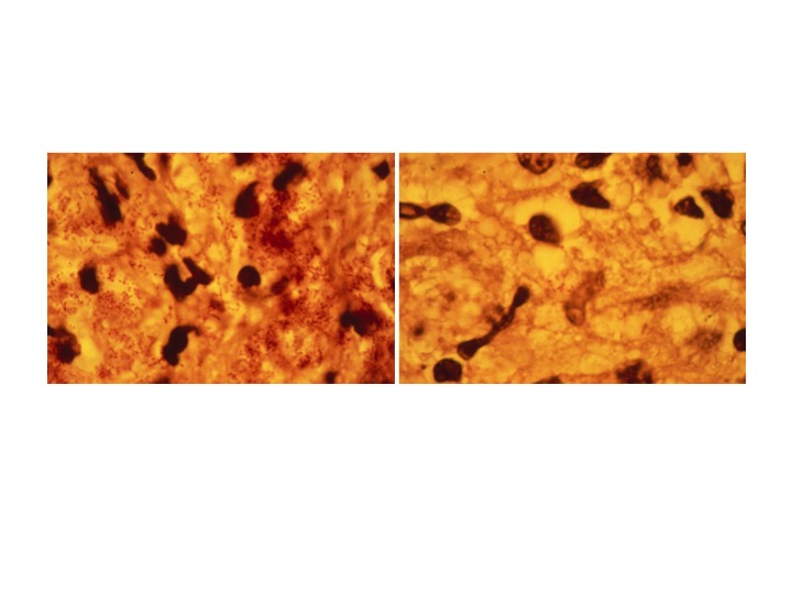  Lepromatous leprosy showing bacilli in macrophages infiltrating the skin (left), and 6 days after injection of interferon-γ (right) (NEJM 1986).