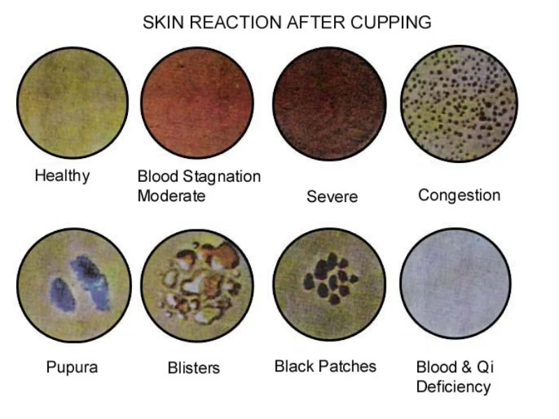 The Cupping method used in UFIT's massage therapy is part of a comprehensive treatment plan, and is less likely to leave dark marks that look like most of them here!