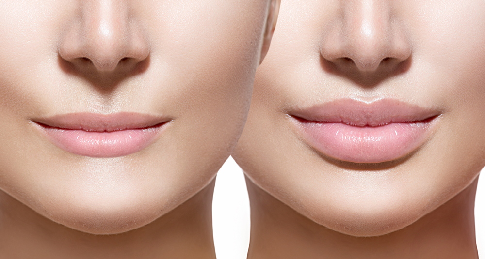 Lip Augmentation