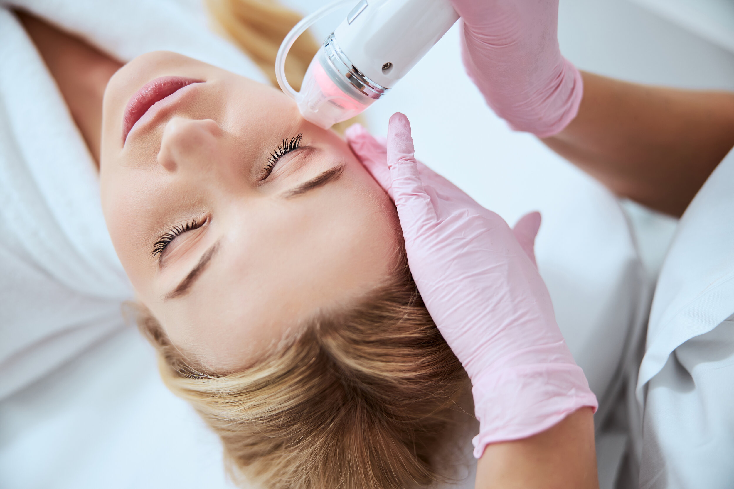 Microneedling with radio frequency (RF)