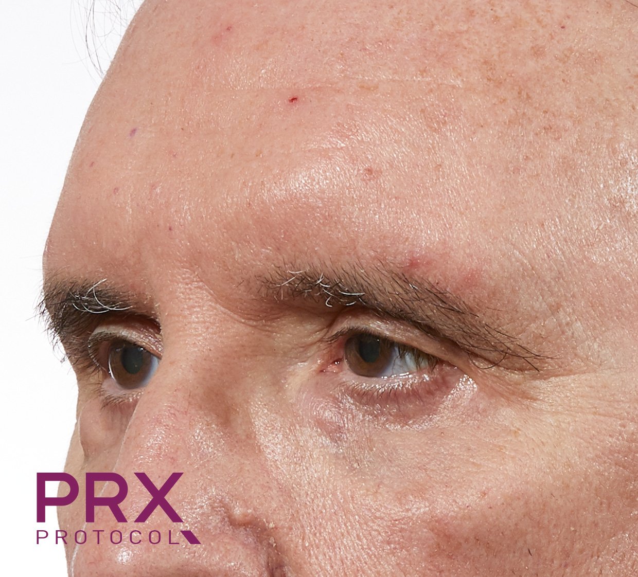Glabella (A) AFTER (6 sessions PRX-T33+WiQo active skin program).jpg