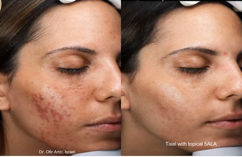 Acne+-+Artzi+(1+tx+with+ALA)+01 (1).png
