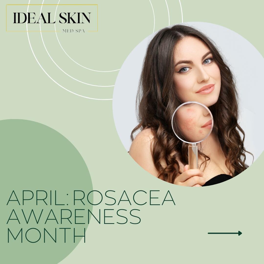 Did you know April is Rosacea Awareness Month?  Do you suffer from Rosacea? It&rsquo;s a condition that affects over 16 million people.  Swipe through to learn more and see how we can help!  Go to idealskinfw.com to see location info and book your co