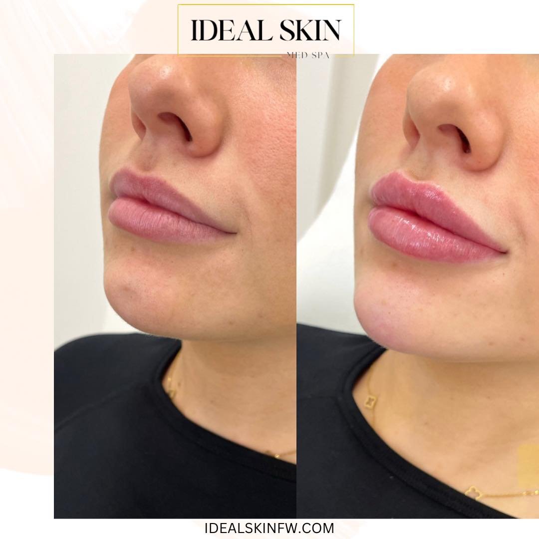 Lip plump and chin balance! 🤌🏼 
Book your consultation or appointment today at idealskinfw.com
#fortworthinjector #chinfiller #lipinjections #dfwinjector #lipfillergoals #lipfillerbeforeandafter #fortworthmedspa #fillerbeforeandafter #lipflip #lipf