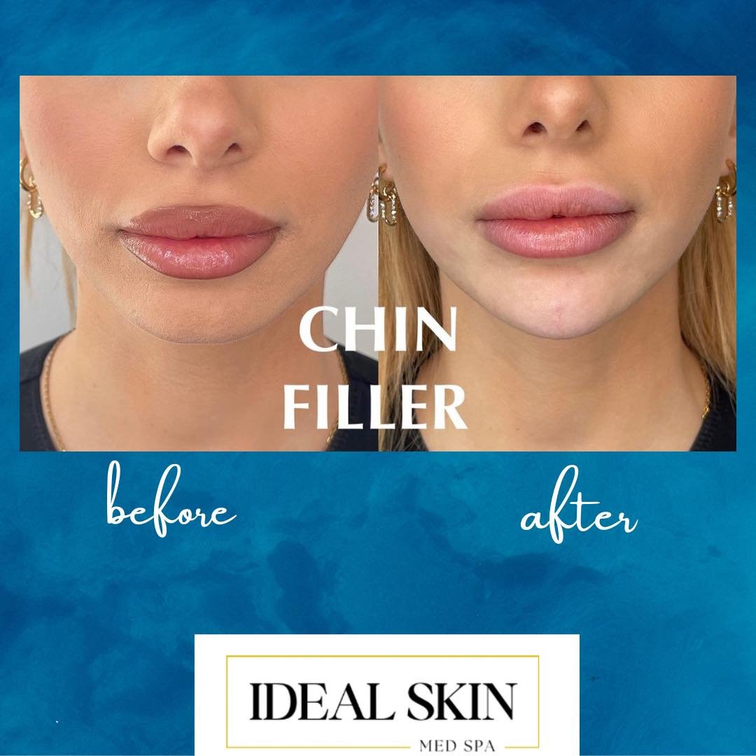 Achieve perfect harmony.  Enhance Your facial balance with precision fillers!
Idealskinfw.com
#jawlineslimming #jawlinecontouring #chinfiller #facialbalancing #facialbalance #facialbalancingwithfillers #fortworthmedspa #fillers #fillerbeforeandafter 