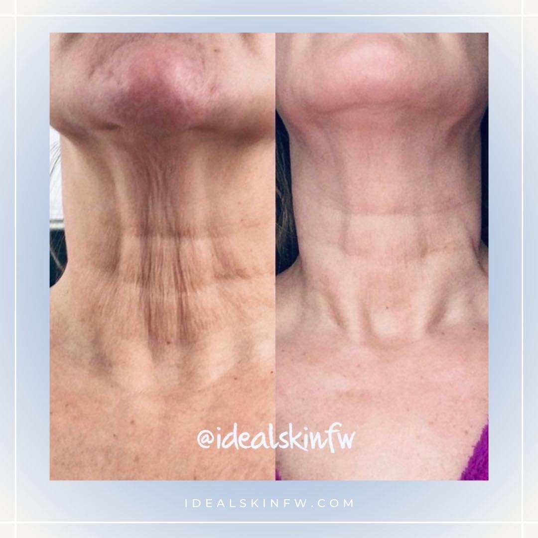 We can take years off your appearance!  Look at these beautiful results.  Schedule your consultation or appointment with us today!  Idealskinfw.com

#skintighteningtreatment #skintightening #fortworthinjector #agingskincare #agingskin #radiessefiller