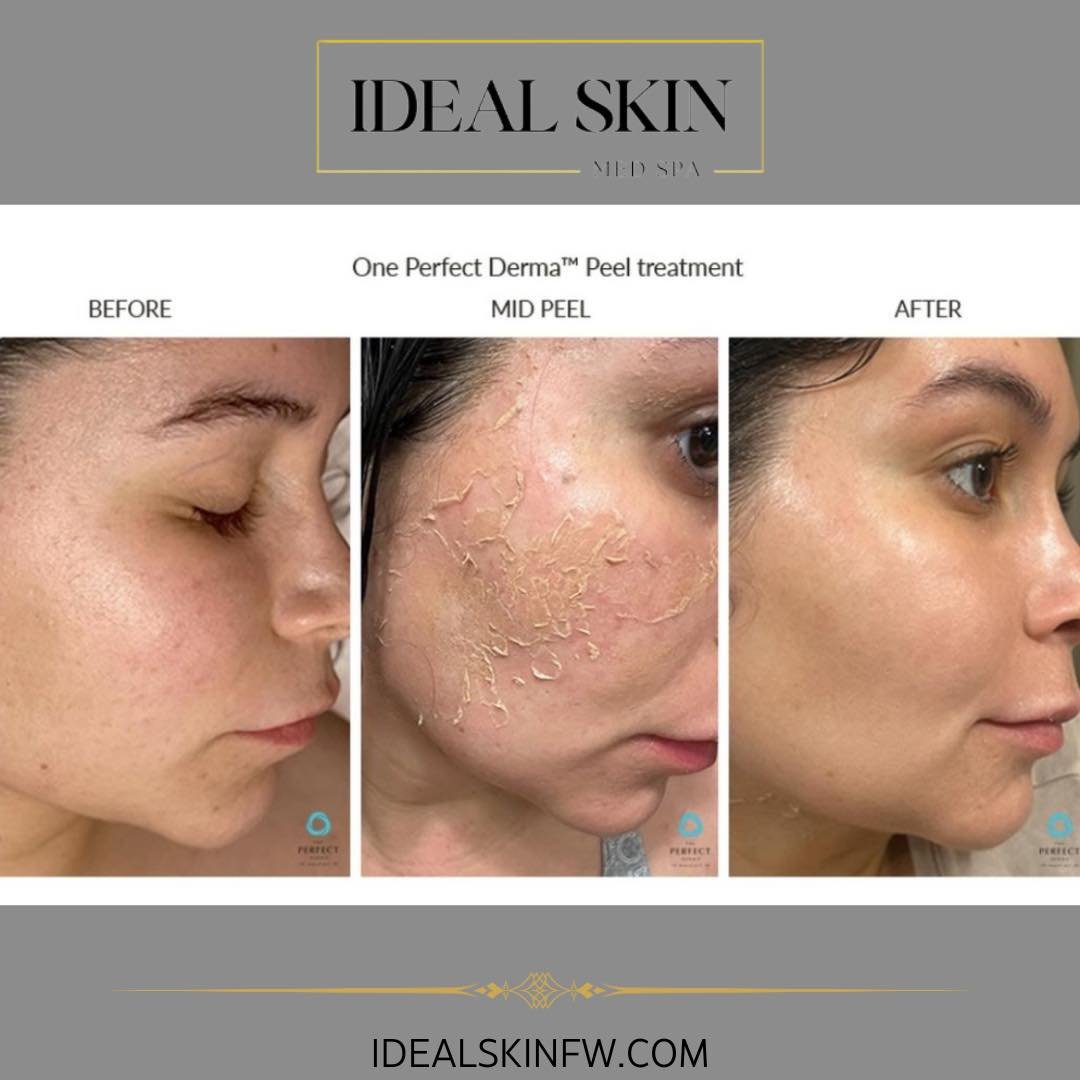 Unveil your perfect glow!  Try a Perfect Derma Peel treatment with us.  Book your appointment now at idealskinfw.com 
#perfectderma #agingskincare #agingskin #chemicalpeel #hydrofacial #perfectdermapeel #fortworthmedspa #decaturtx #dfwmedspa #west7th