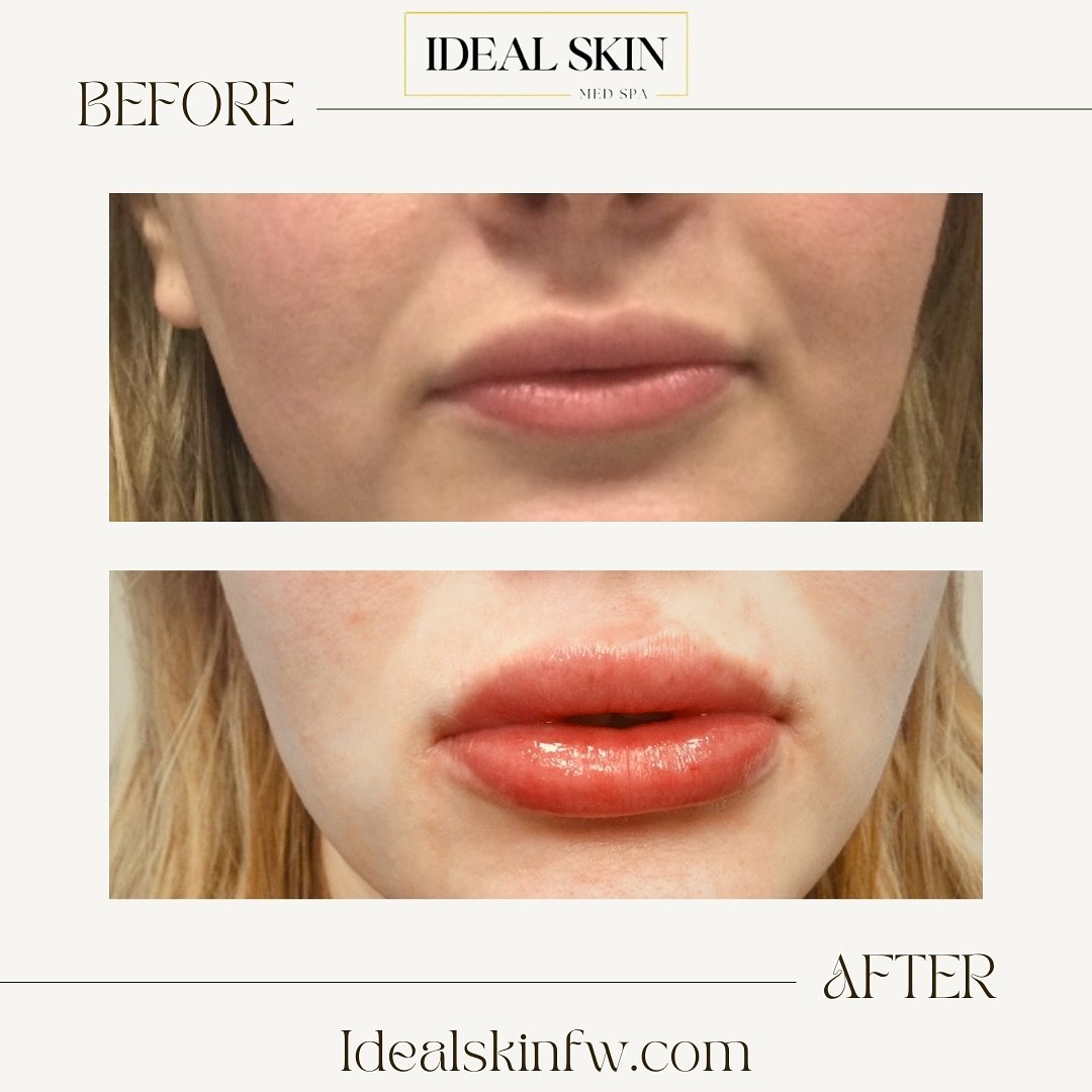 Love a juicy lip plump 👄! Treat yourself or Mom this week.  Taking appointments now at idealskinfw.com 
#fortworthinjector #radiesse #lipinjections #dfwinjector #lipfillergoals #lipfillerbeforeandafter #fortworthmedspa #fortworthmoms #fillers #fille