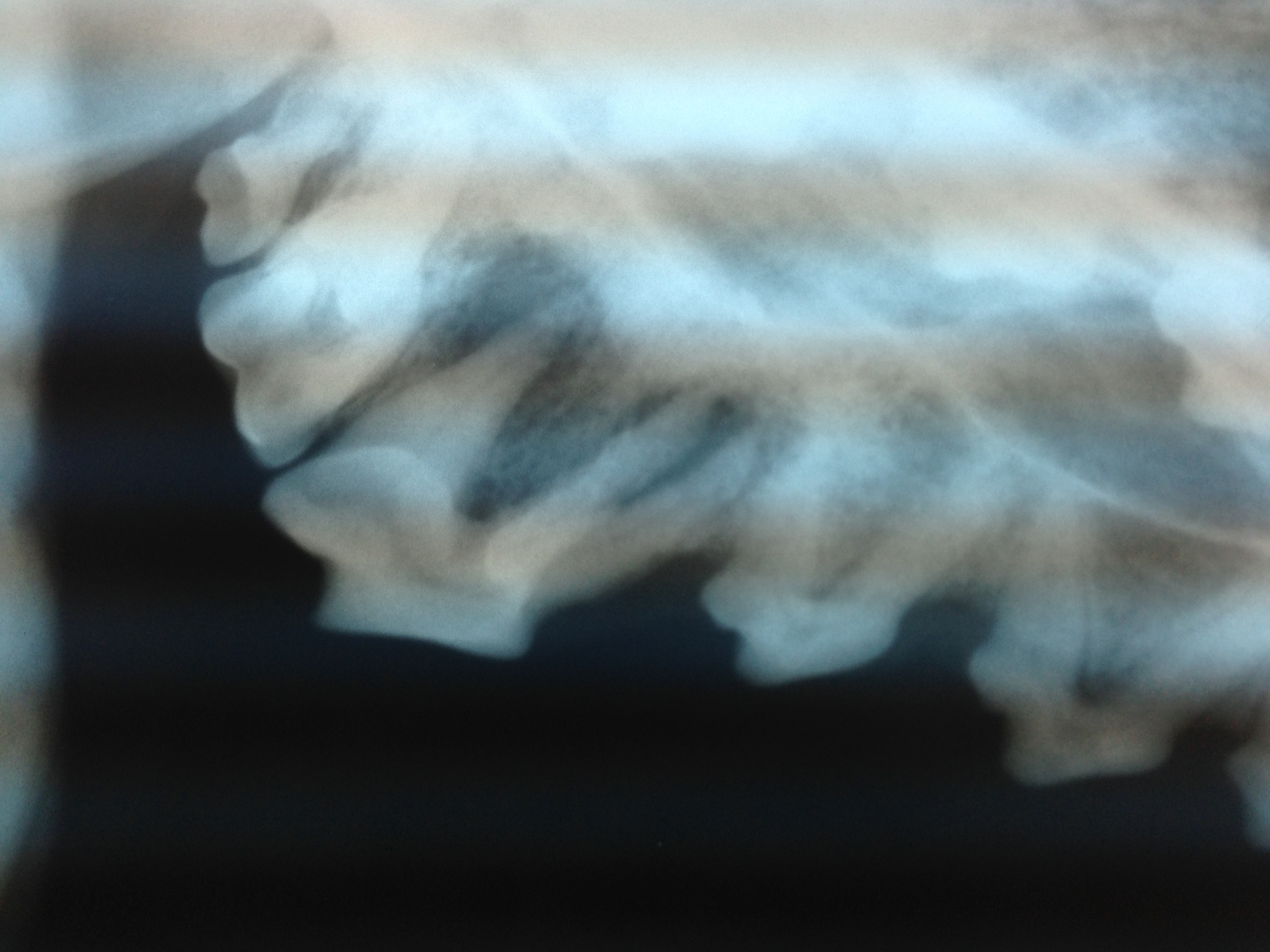 Apical Root Abscess Xray 