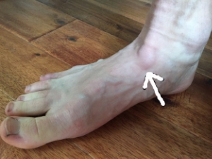 Runner's Bump