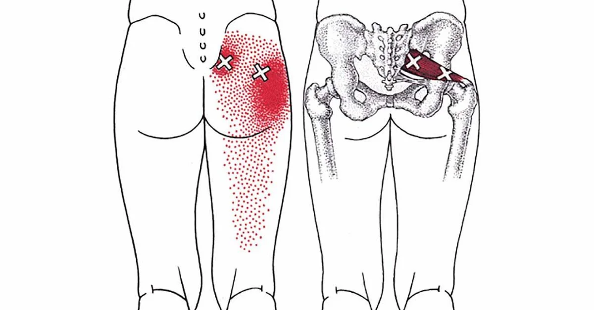 Get-Rid-Of-Sciatica.jpg