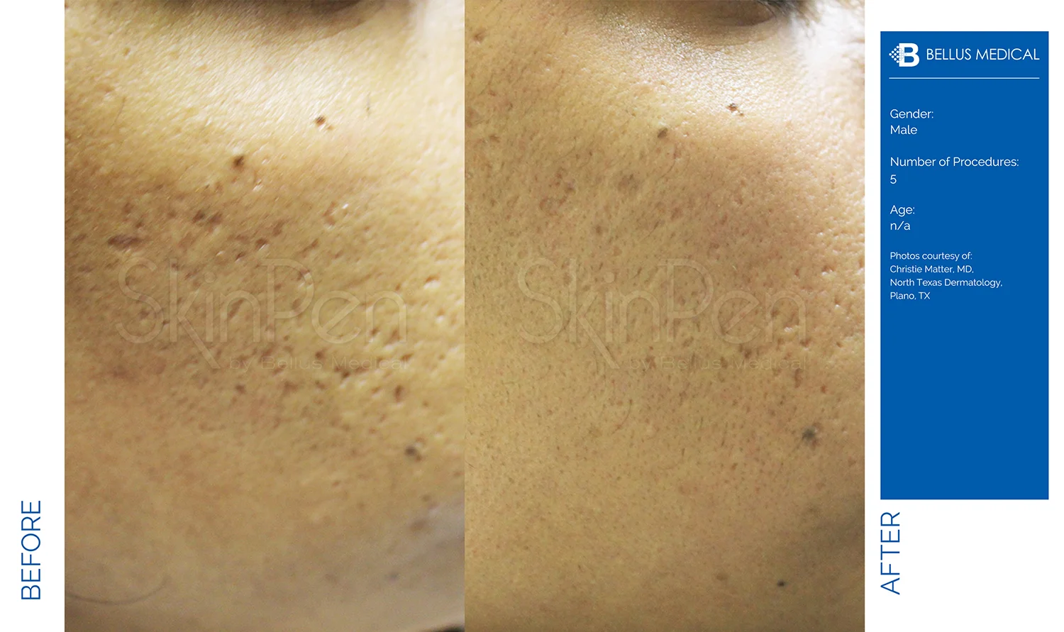 Complexions Skincare Medspa - Before & After 12