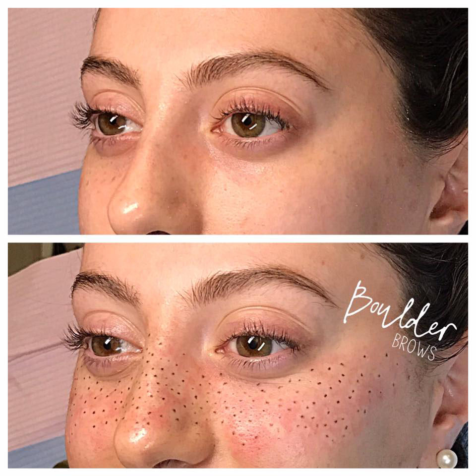 Top: Before | Bottom: After Freckle Tattoo
