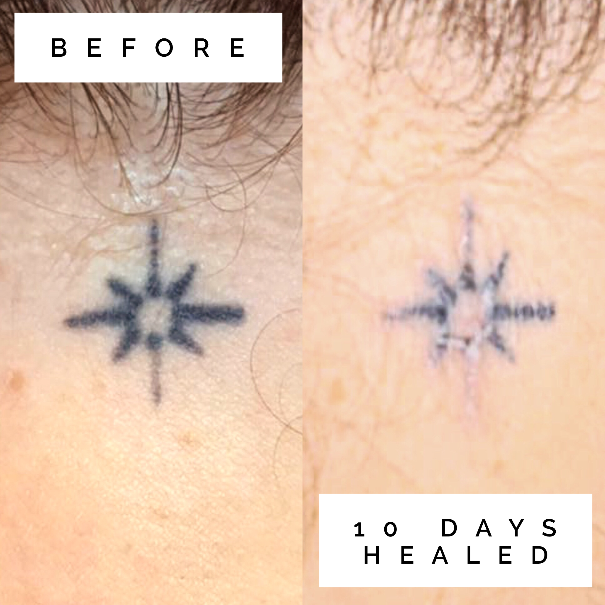 Xtreme Ink helps Kentuckiana erase mistakes with new laser for tattoo  removal  Louisvillecom