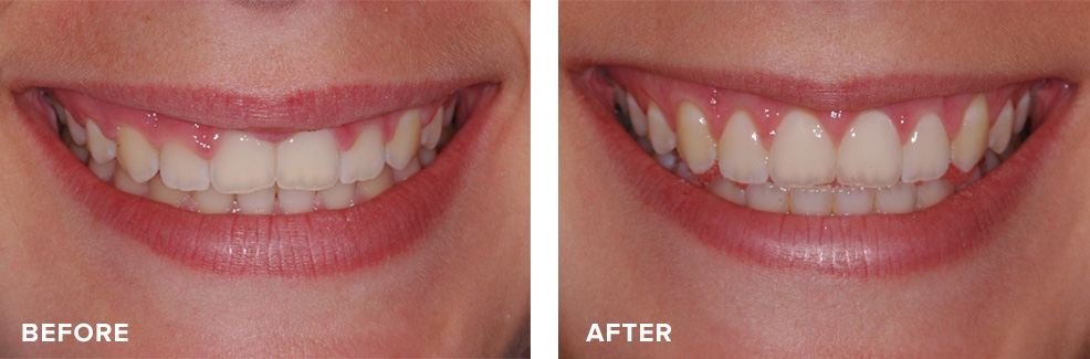 Aesthetic crown lengthening for gummy smile