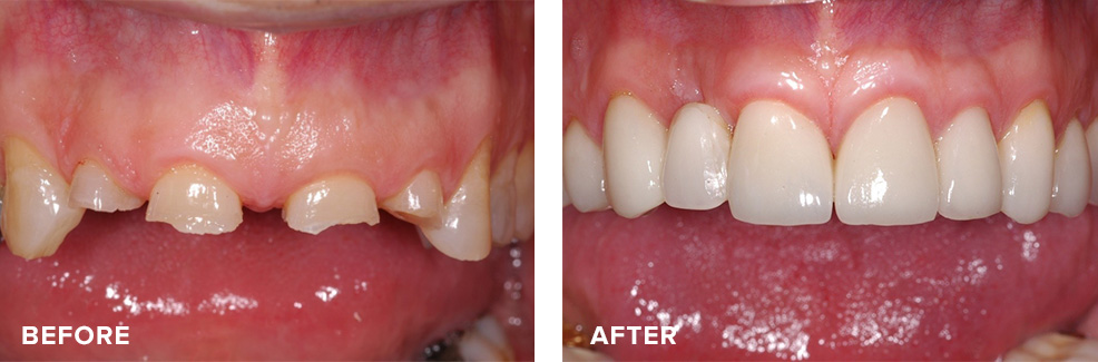 Anterior crown lengthening prior to having crowns placed