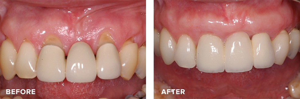Gum graft to improve aesthetics around an existing bridge