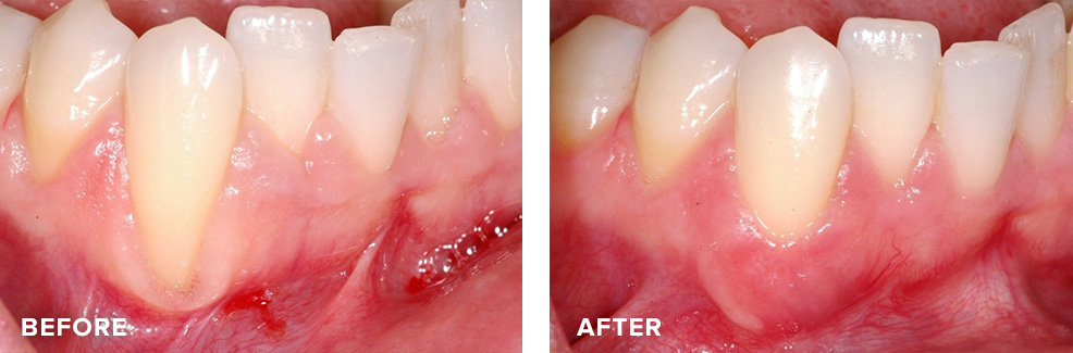 Gum tissue borrowed from adjacent tooth to address recession