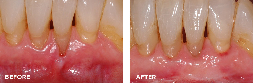 Gum graft to address recession and restore a healthy band of gum tissue around teeth