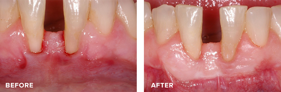 Free gum graft to improve provide a healthy band of gum