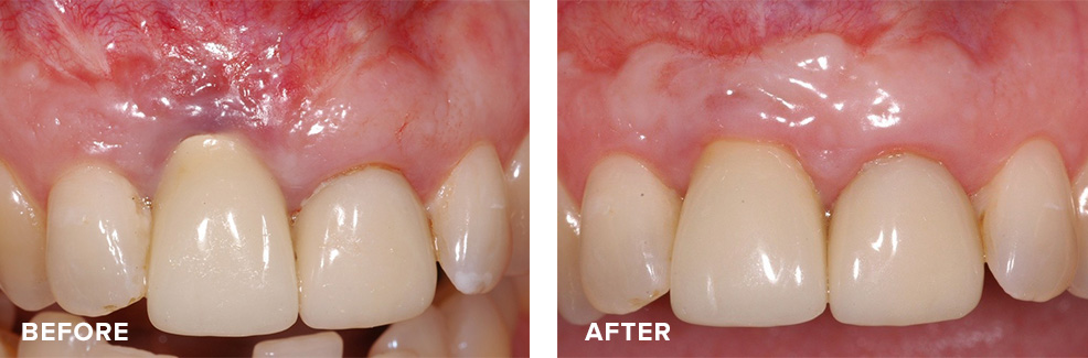 Combined gum graft and crown lengthening to address recession if previously placed implant