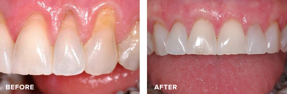 Gum graft to eliminate recession and harmonize gingival line for improved aesthetics