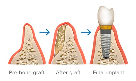 Pre-bone graft, after graft, final implant
