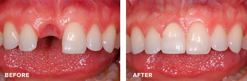 A removable denture replaced by an implant and crown