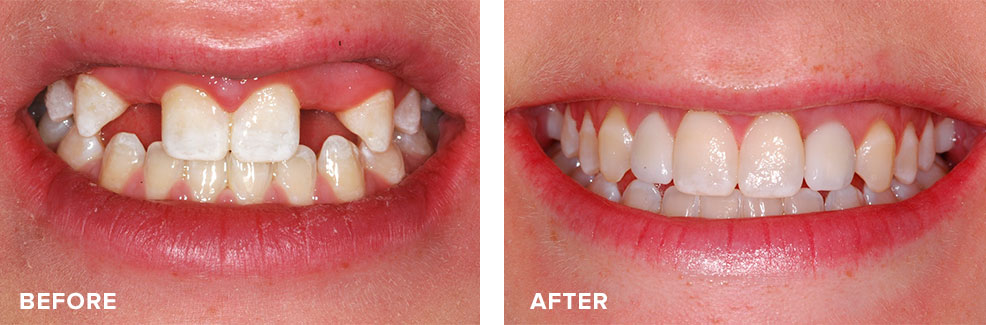 Implants used to improve a young person’s smile