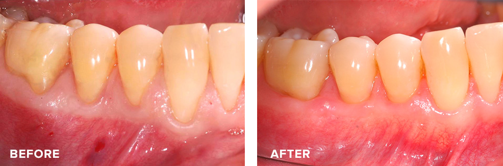 Four teeth with receded gums treated simultaneously