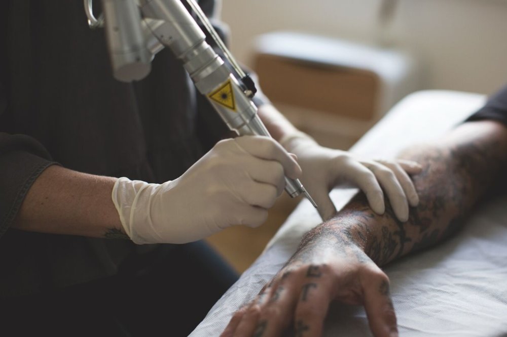 TATTOO REMOVAL — UNSEEN TATTOO TATTOO REMOVAL — UNSEEN TATTOO