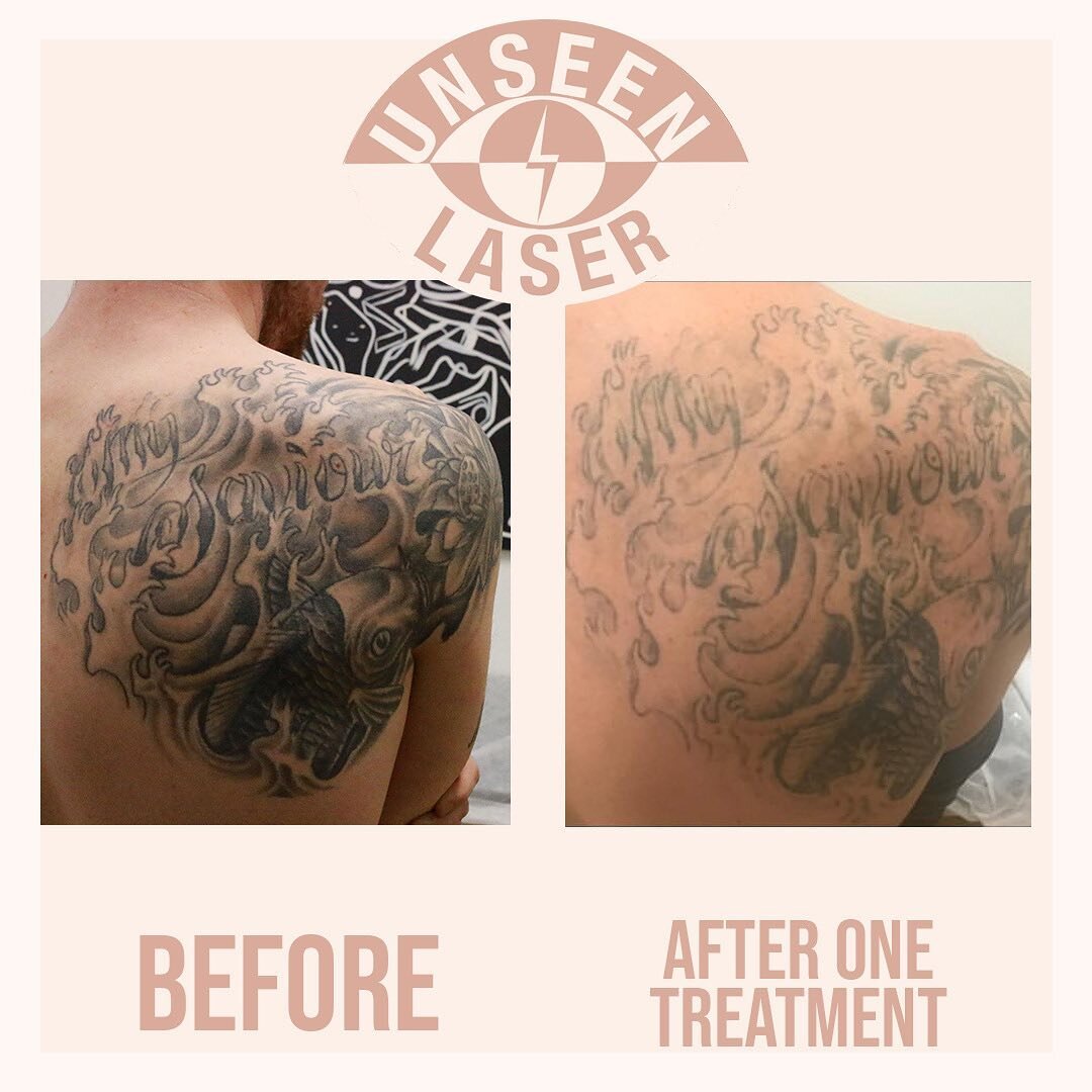 TATTOO REMOVAL — UNSEEN TATTOO TATTOO REMOVAL — UNSEEN TATTOO