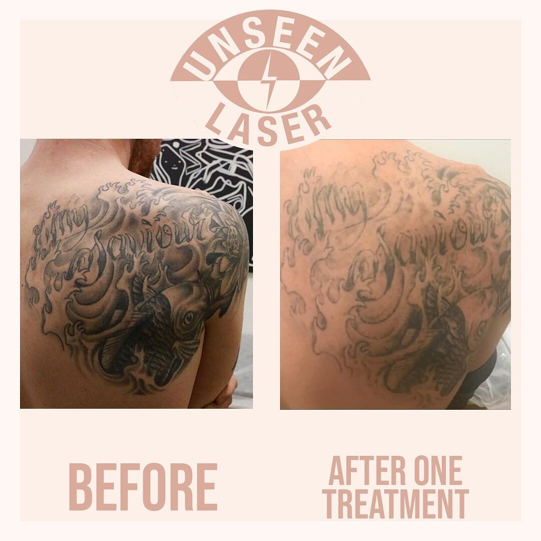 Unseen Laser offers free non obligation consultations to discuss in depth how the laser works and how laser can help you lightening or removal your unwanted tattoo. Book your free consultation using out online booking system!
 
⚡️Professional advice 