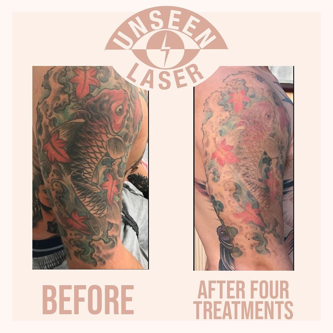 Before and after four treatments on black only.
Ready for a great cover up 

Unseen Laser offers free non obligation consultations to discuss in depth how the laser works and how laser can help you lightening or removal your unwanted tattoo. Book you