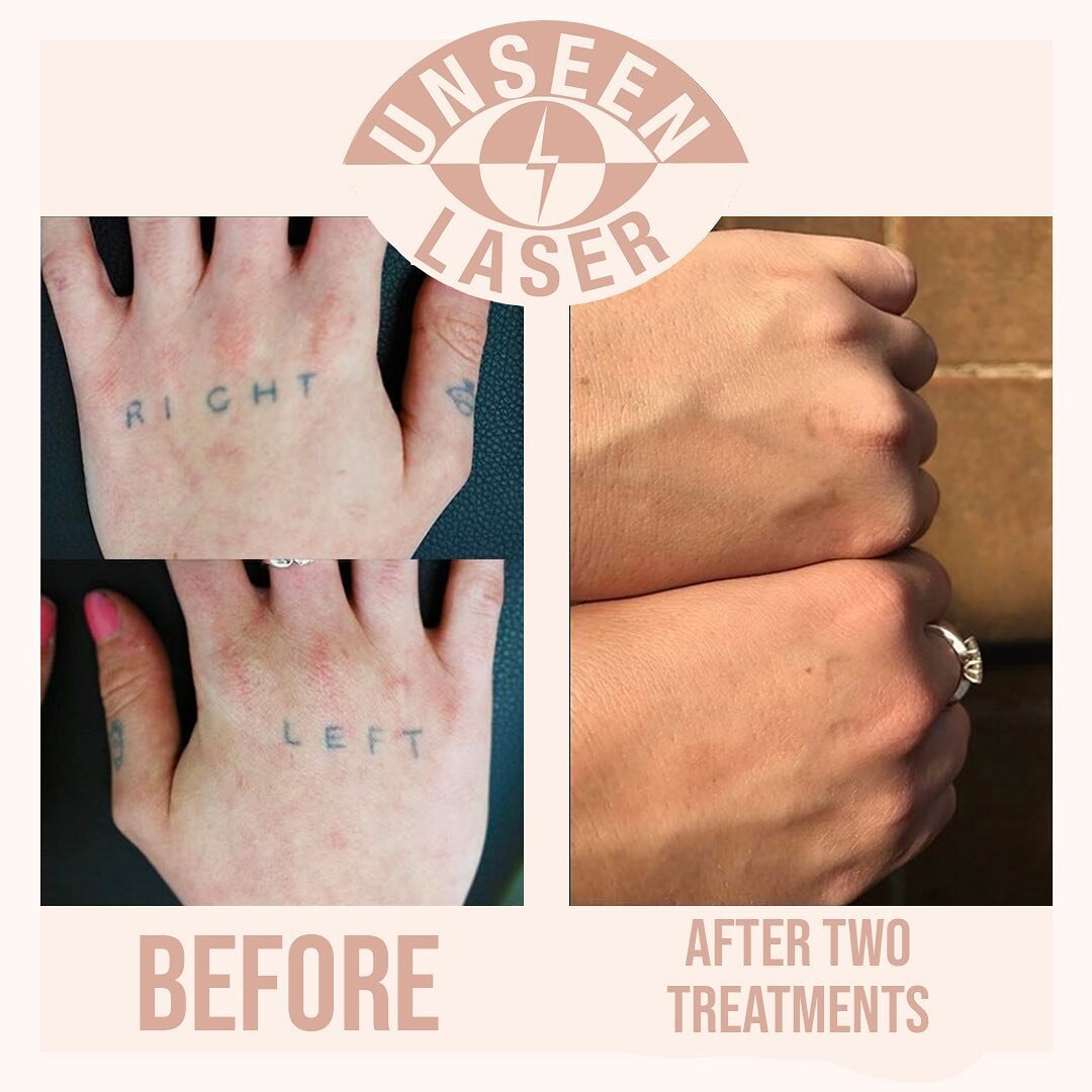 Before and after two treatments. Want to know more about tattoo removal and how Unseen Laser can help you lighten or remove an unwanted tattoo? Get in touch today! 0423833648 info@unseenlaser.com