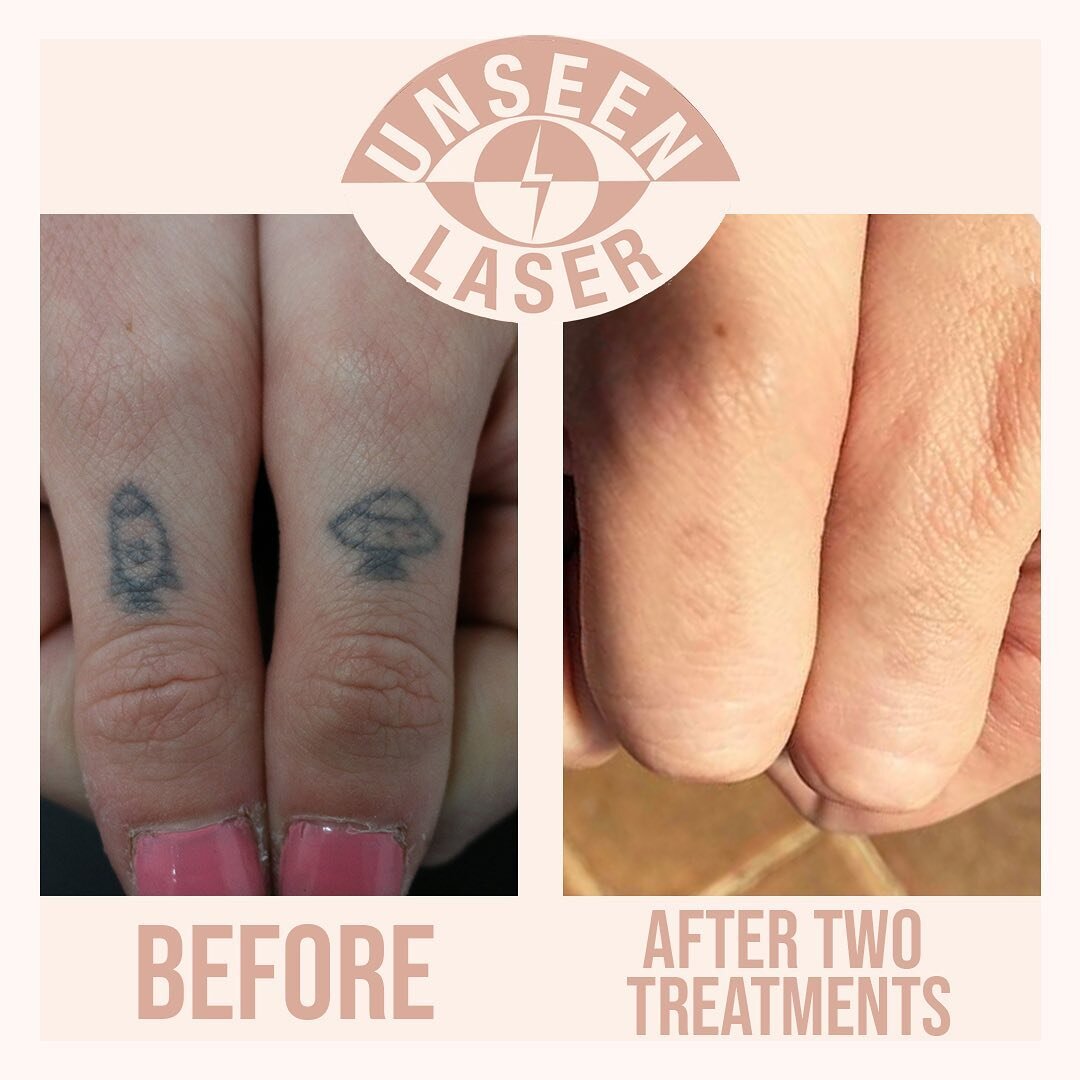 Awesome results before and after two treatments on these finger tattoos. To find out more about how Unseen Laser can help you lighten or remove your unwanted tattoo get in touch today. We offer free consultations to discuss in depth your options, tre