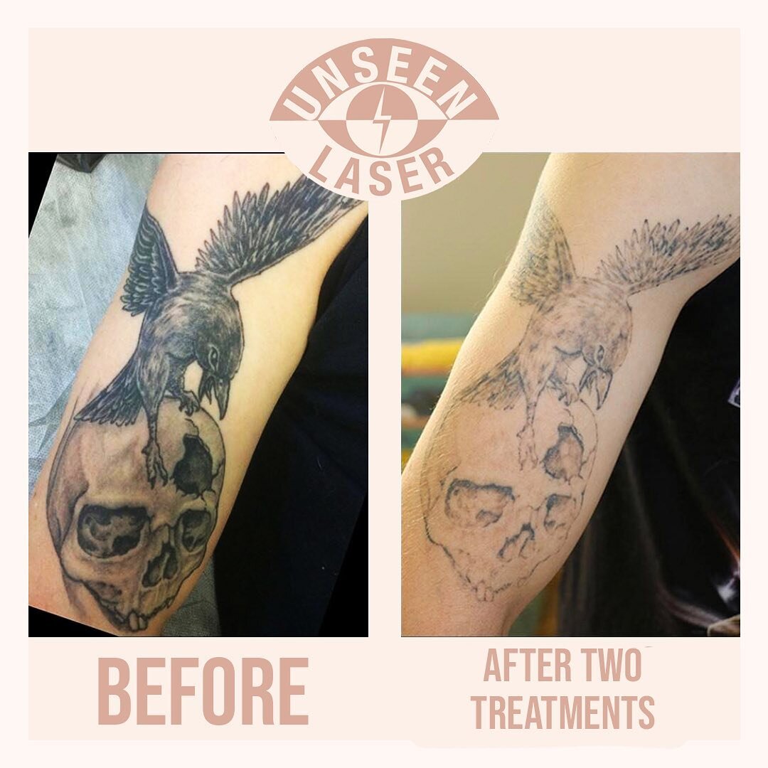 Before and after 2 treatments.  To learn more about how Unseen Laser can help you lighten or remove an unwanted tattoo get in touch today. ⚡️Professional advice ⚡️Comfortable environment ⚡️Fast results ⚡️Best price guaranteed 📞0423833684
🖥www.unsee