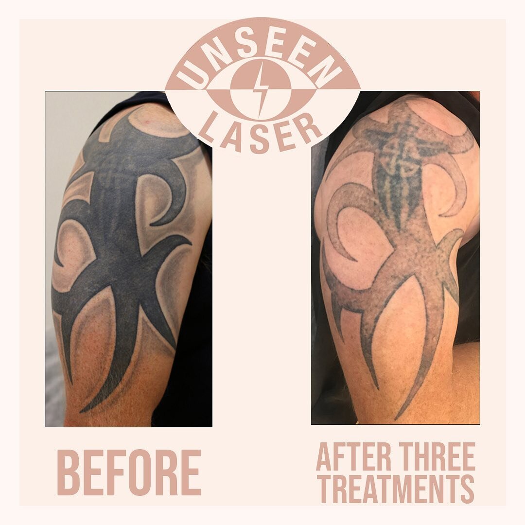 Awesome results before and after 3 treatments on this bold tribal cover up. To learn more or get a free quote text 0423833648. ⚡️Professional advice ⚡️Comfortable environment ⚡️Fast results ⚡️Best price guaranteed 📞0423833684
💻info@unseenlaser.com
