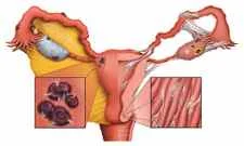 Endometriosis & Fibroids, A True Curse.