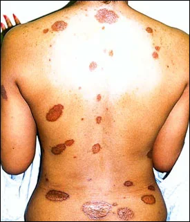 Living With Sarcoidosis
