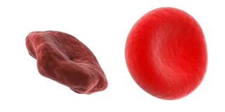 Unhealthy vs. healthy red blood cell