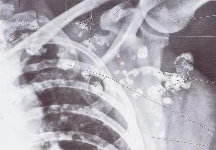 Lymph nodes under the arm and along the chest cavity.