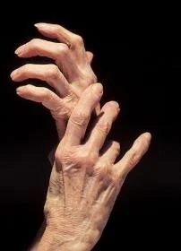 Arthritis Hands.jpg