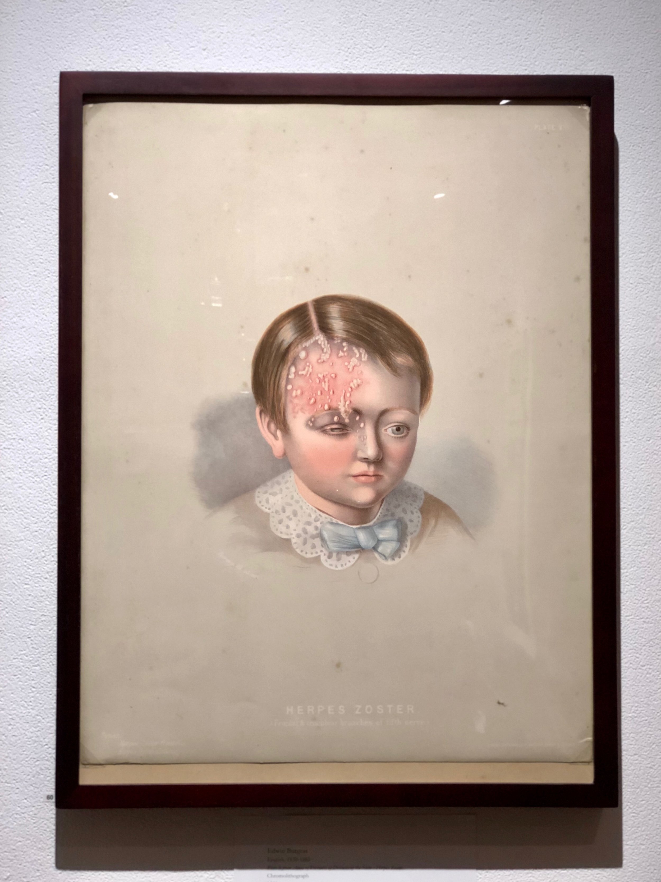 surgicalmuseumherpes.JPG