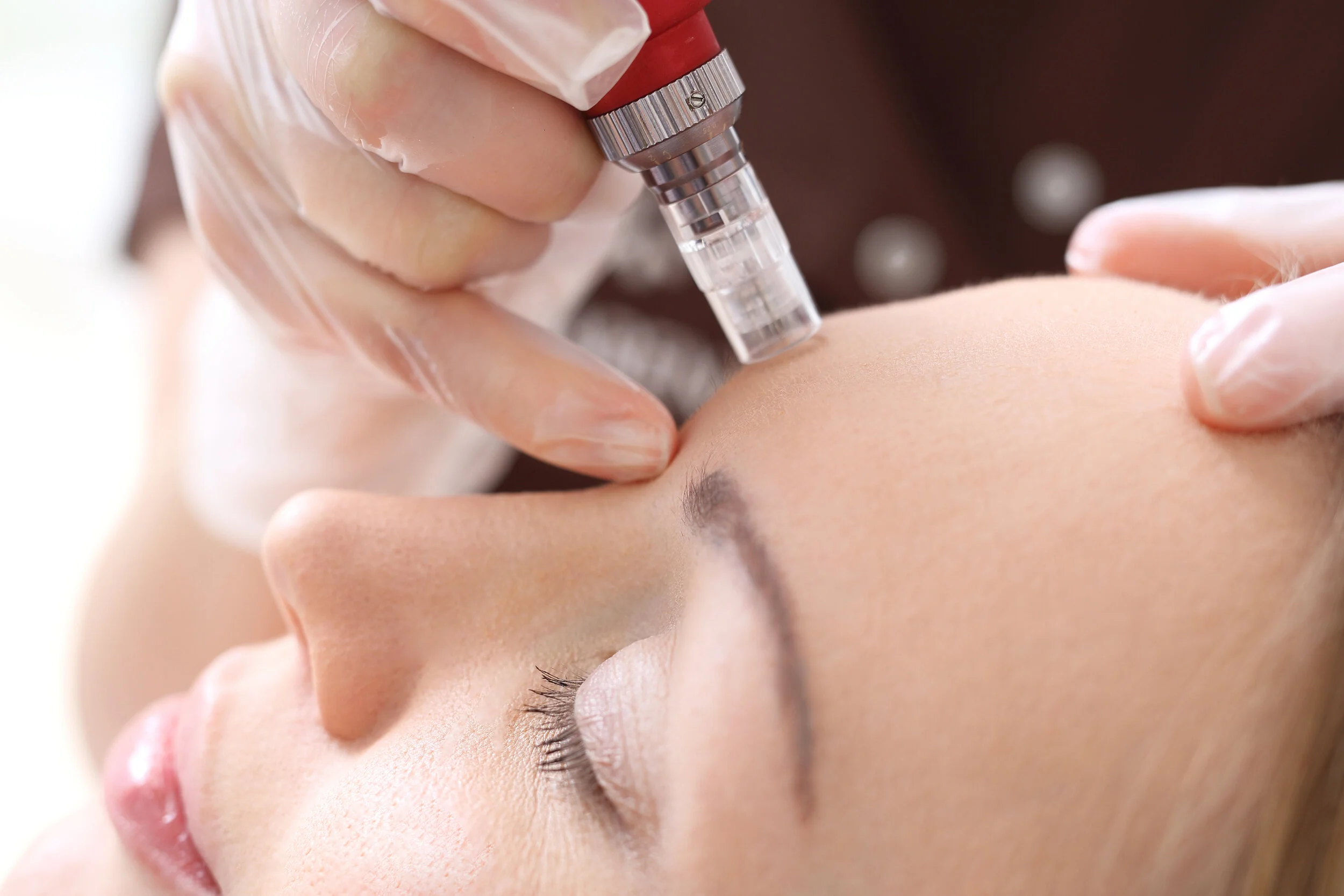 Does Microneedling Help Reduce Signs of Aging?