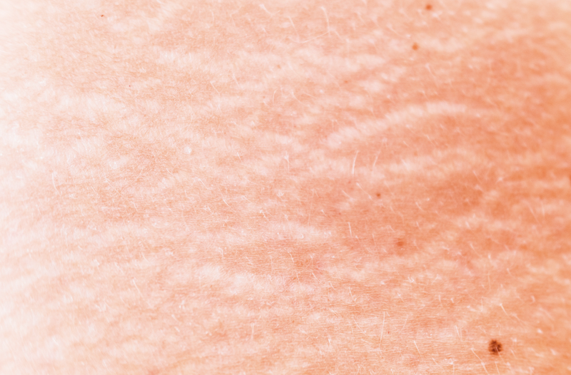 Stretch Marks in Pregnancy — Skin Depth Dermatology