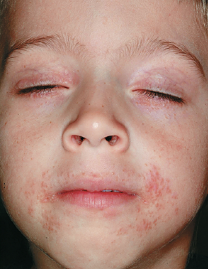 PERIORAL DERMATITIS — Skin Depth Dermatology