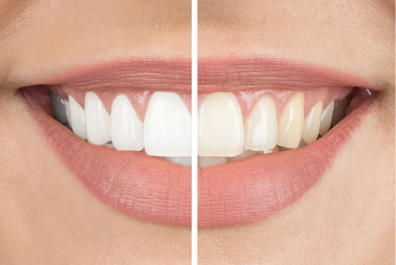 images_cosmetic-whitening.jpg